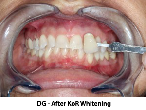 Andover dentist | Kor Teeth Whitening testimonials, berfore and after | Dr Wojtkun
