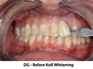 Andover dentist | Kor Teeth Whitening testimonials, berfore and after | Dr Wojtkun