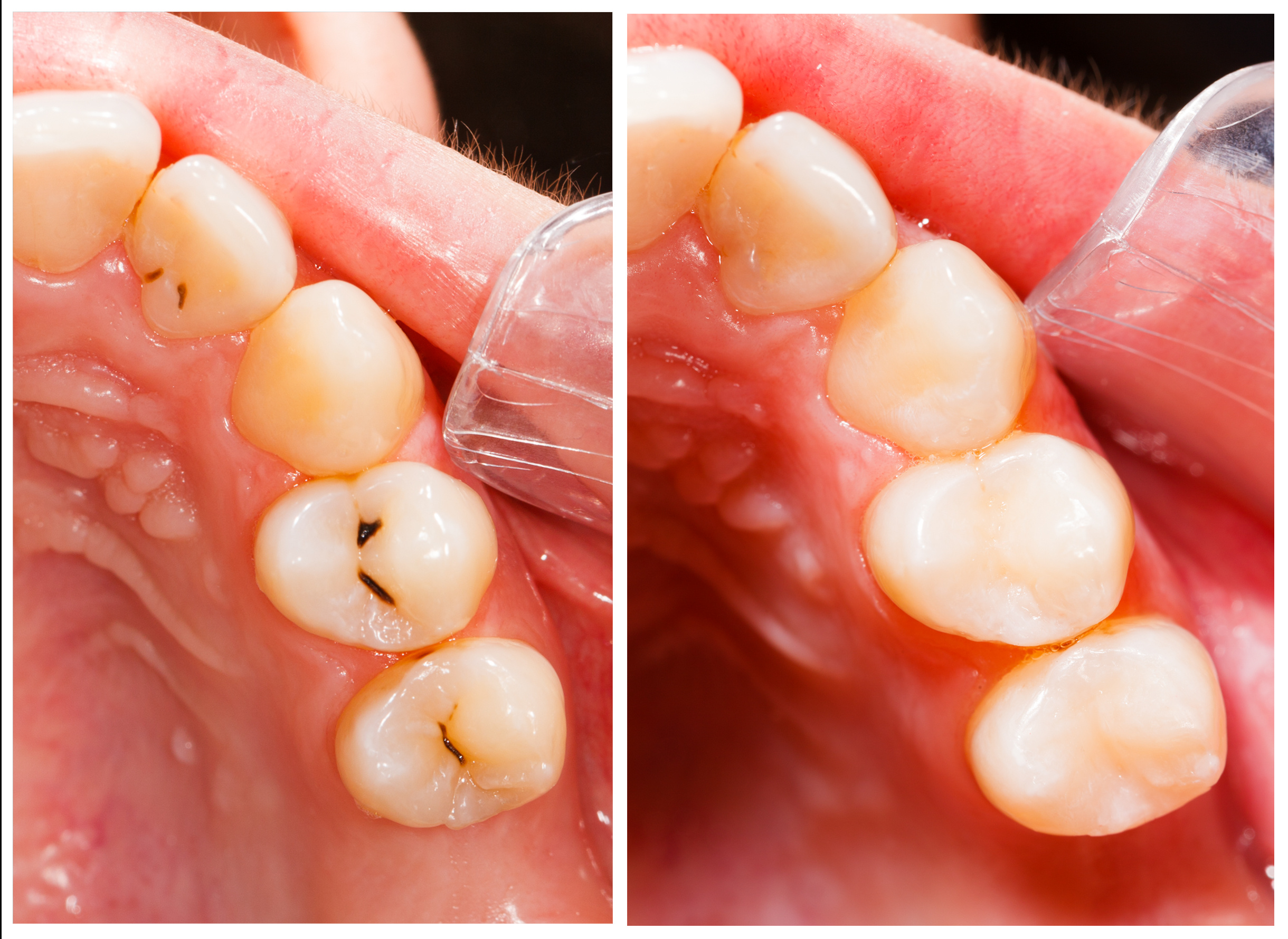 Andover dentists | white tooth colored fillings | silver fillings  |  Dr Wojtkun | Dr Sendek