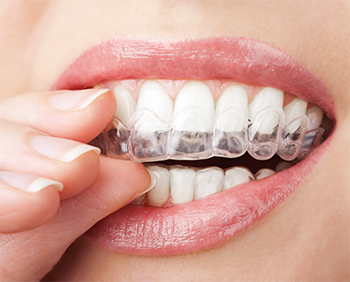 Andover braces | Invisialign clear braces