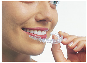 Andover dentists | Invisalign clear braces